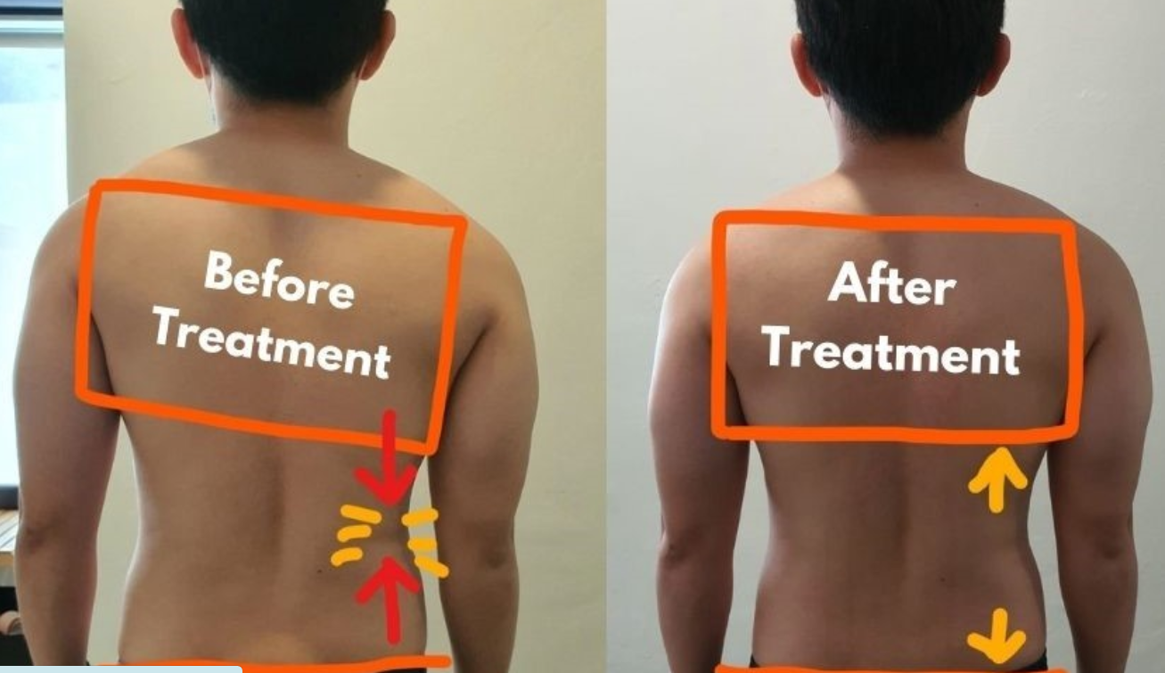 myo-release-back-elevated-on-one-side